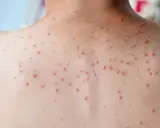 Vue rapprochée du dos d'une personne couverte de petits boutons rouges, possiblement dus à une infection virale comme la varicelle.