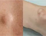 Gros plan sur une peau avec des taches de rousseur et une boule de graisse sous-cutanée sur le bras.