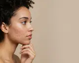 Profil d'une jeune femme avec de l'acné sur la joue, illustrant l'effet du sucre sur la peau.