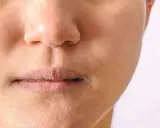 Peau sèche et squameuse autour du nez et des lèvres, signe d'un manque de sébum.