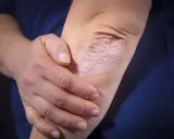 Une personne touche son coude, révélant une plaque de psoriasis inversé, rouge et squameuse, sur sa peau.