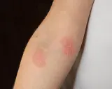 Deux plaques rouges sur un bras, ressemblant à un bouton rouge avec point blanc, indiquent une irritation cutanée.