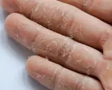 Gros plan sur des mains qui pèlent, signe visible de stress. La peau se détache en fines lamelles sur les doigts.