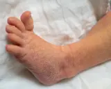 Pied de bébé avec peau sèche et squameuse, évoquant le psoriasis bébé.