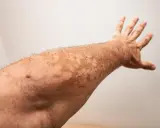 Bras tendu révélant des taches claires dues à un vitiligo léger.