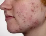 Gros plan sur le visage d'une jeune femme, montrant une peau rougie avec de nombreux comédons et boutons d'acné.