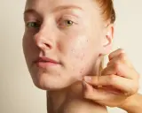 Une main applique un petit pansement transparent sur un bouton d'acné sur le visage d'une jeune femme rousse.