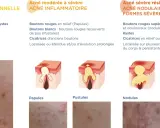 Illustration des différents types d'acné : rétentionnelle, inflammatoire, nodulaire et kystique. Chaque type d'acné est décrit avec ses caractéristiques et représenté par des schémas et des photos.