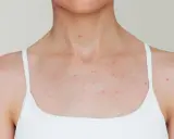Poitrine et cou d'une personne portant un débardeur blanc, avec de nombreux petits boutons rouges visibles sur la peau.