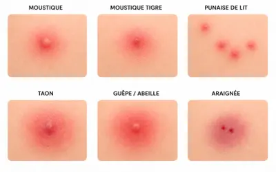 Six images montrant des piqûres d'insectes et d'araignées, certaines semblant faire murir un bouton.