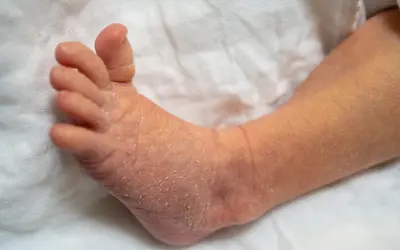 Pied de bébé avec peau sèche et squameuse, évoquant le psoriasis bébé.