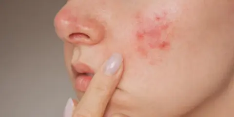 Gros plan sur une joue avec un bouton d'eczéma rouge et irrité, une personne touche délicatement la zone affectée.