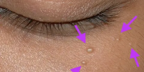 Gros plan sur la peau près de l'œil, montrant plusieurs petits points blancs, des grains de milium percer, indiqués par des flèches violettes.