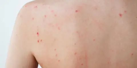 Éruption cutanée sur le dos, avec de nombreux petits points rouges, certains semblant être un bouton inflammatoire douloureux.