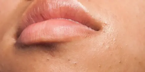 Gros plan sur des lèvres roses et une peau présentant plusieurs points noirs, ces petites imperfections qui peuvent apparaître sur le visage.
