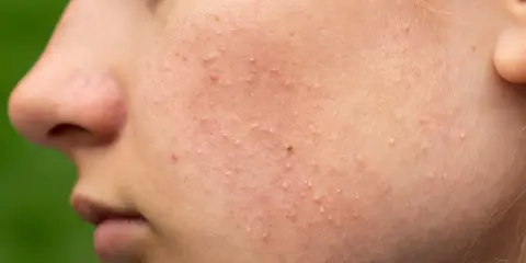 Gros plan sur la joue d'une personne avec de nombreux petits boutons, un bouton de stress qui gratte, et quelques rougeurs.