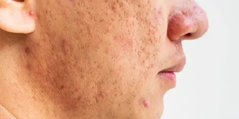 Gros plan sur le visage d'une personne montrant des cicatrices et des rougeurs dues à une acné sévère.