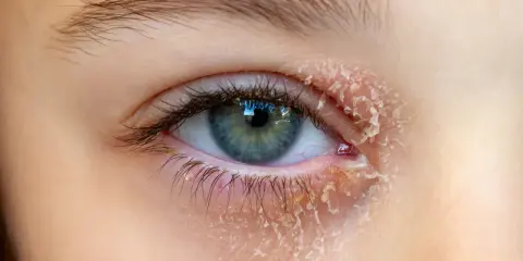 Œil avec peau sèche et squameuse autour, symptôme d'un eczéma paupière.