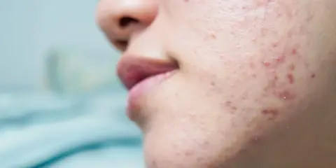 Gros plan sur une peau acnéique, montrant des rougeurs et des imperfections. Ce type d'acné peut être lié à l'effet de la progestérone sur la peau.