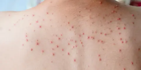 Vue rapprochée du dos d'une personne couverte de petits boutons rouges, possiblement dus à une infection virale comme la varicelle.