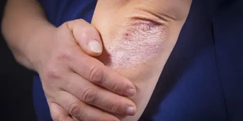 Une personne touche son coude, révélant une plaque de psoriasis inversé, rouge et squameuse, sur sa peau.