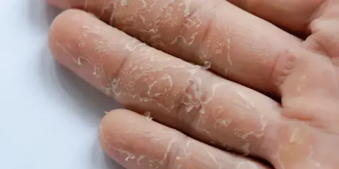 Gros plan sur des mains qui pèlent, signe visible de stress. La peau se détache en fines lamelles sur les doigts.