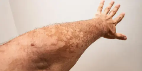 Bras tendu révélant des taches claires dues à un vitiligo léger.