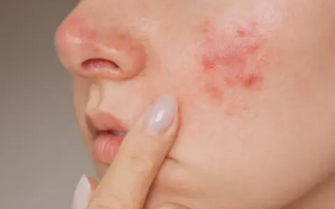 Gros plan sur une joue avec un bouton d'eczéma rouge et irrité, une personne touche délicatement la zone affectée.
