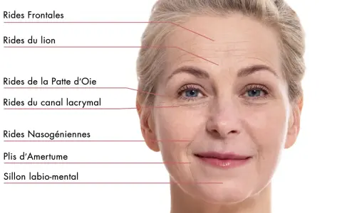 Visage d'une femme montrant les rides du visage signification : frontales, du lion, patte d'oie, canal lacrymal, nasogéniennes, plis d'amertume, sillon labio-mental.