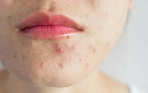 Gros plan sur le bas du visage d'une personne, montrant des imperfections et un bouton sans pu près de la bouche.