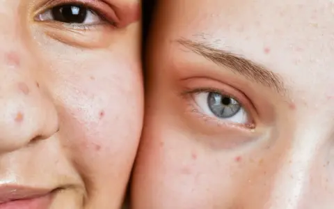 Gros plan sur deux visages, montrant des imperfections cutanées, un bouton stress visible sur la joue de l'une d'elles.