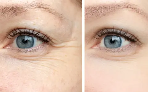 Comparaison avant/après : la peau déshydratée montre des rides marquées autour de l'œil, tandis que la peau hydratée apparaît lisse et repulpée.