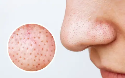 Gros plan sur le nez montrant des filaments sébacés dans les pores. Une loupe révèle la texture de la peau, suggérant des remèdes maison pour les imperfections.