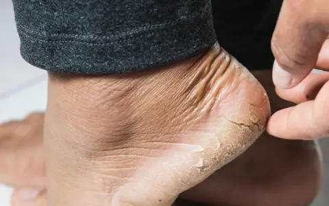 Gros plan sur un talon sec et craquelé, signe de xérose pied. La peau est rugueuse et des lambeaux se détachent.