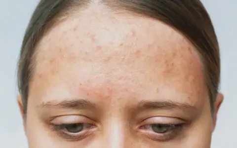 Front de la peau avec des rougeurs et des imperfections, signes d'acné rétentionnelle.