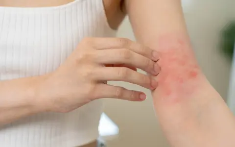 Une personne se gratte le bras, révélant un petit bouton sur les bras allergie, rouge et irrité.