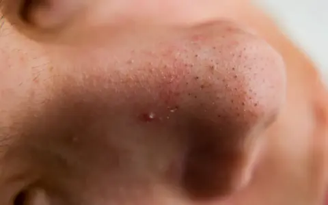 Gros plan sur un nez avec des pores visibles et un bouton avec point noir au milieu.