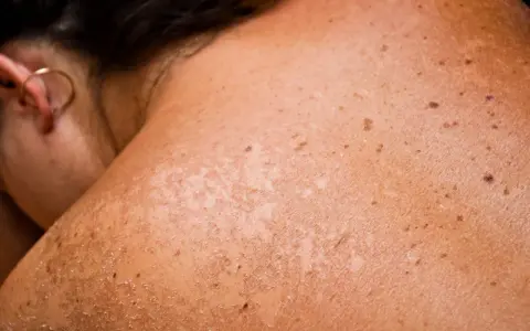 Gros plan sur une épaule et un cou montrant une peau bronzée avec des taches brunes et des zones de peau qui pèle, signe d'un coup de soleil.