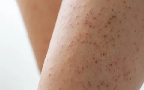 Gros plan sur une peau présentant de petites rougeurs et aspérités, signe d'un excès de kératine peau.