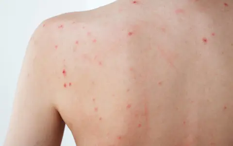 Éruption cutanée sur le dos, avec de nombreux petits points rouges, certains semblant être un bouton inflammatoire douloureux.