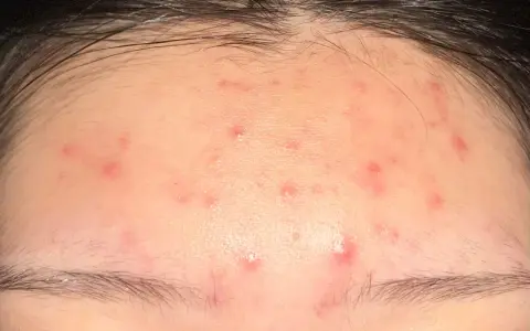 Plusieurs petits boutons rouges parsèment le front, sous la ligne des cheveux.