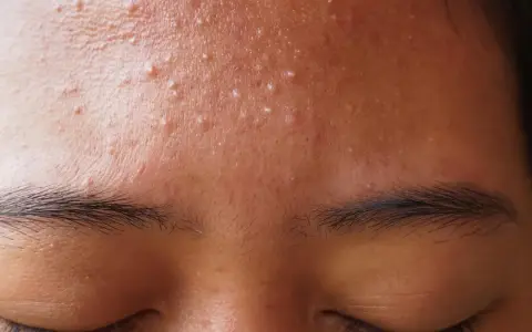 Gros plan sur le front d'une personne avec de nombreux petits boutons blancs, signe d'une peau à imperfections.