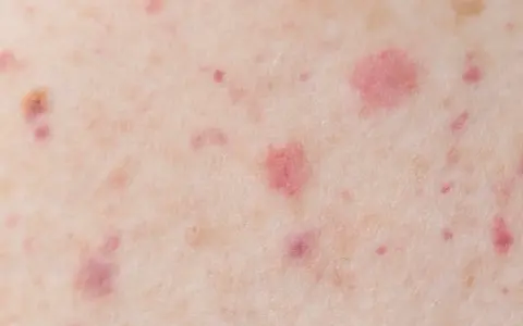 Gros plan sur une peau présentant des pétéchies et des signes de vieillissement cutané, avec des taches rouges et des irrégularités de texture.