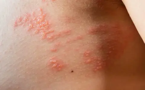 Peau irritée avec un petit bouton cloque qui gratte, formant des grappes rouges et enflammées.