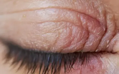 Gros plan sur un œil fermé, montrant des paupières sèches et irritées avec des ridules et des squames.