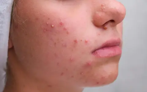 Gros plan sur un visage avec de nombreux boutons blancs et rouges, signe d'une peau à problèmes.
