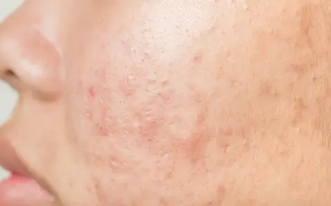 Gros plan sur la peau d'un adulte présentant des rougeurs et des marques, typiques d'un bouton visage adulte.