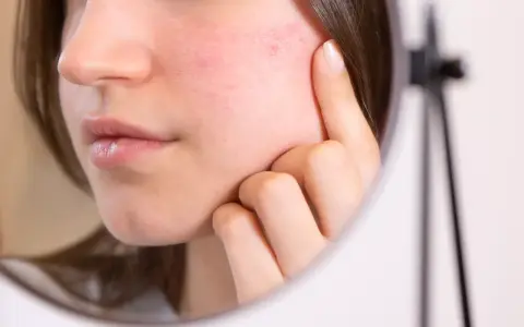 Gros plan sur un visage reflété dans un miroir, montrant une rougeur diffuse et des petits points rouges, signe d'un érythrose du visage.