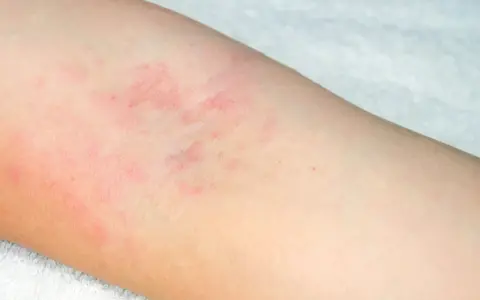 Début d'eczéma sur le bras, avec des plaques rouges et irritées sur la peau claire.