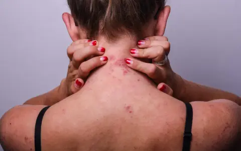 Une personne se gratte le cou et l'épaule, révélant des rougeurs et des irritations dues à l'eczéma.